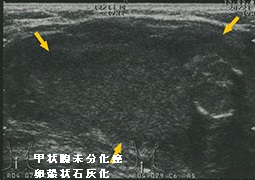 甲状腺未分化癌 卵殻状石灰化 甲状腺未分化癌 卵殻状石灰化