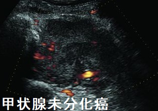 甲状腺未分化癌 ドプラー 甲状腺未分化癌 ドプラー