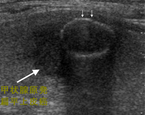 甲状腺原発扁平上皮癌 卵殻状石灰化 甲状腺原発扁平上皮癌 卵殻状石灰化