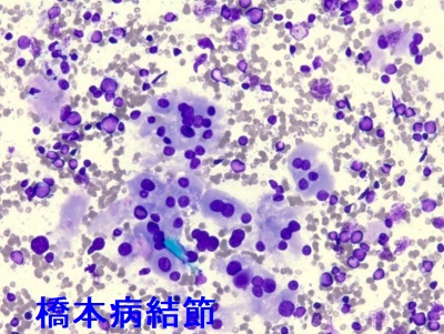 橋本病結節 好酸性細胞・リンパ球浸潤 橋本病結節 好酸性細胞・リンパ球浸潤