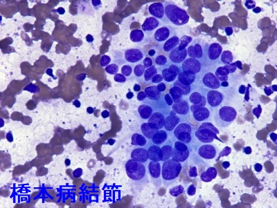橋本病結節 好酸性細胞・リンパ球浸潤 橋本病結節 好酸性細胞・リンパ球浸潤