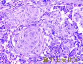 甲状腺乳頭癌扁平上皮化生 甲状腺乳頭癌扁平上皮化生