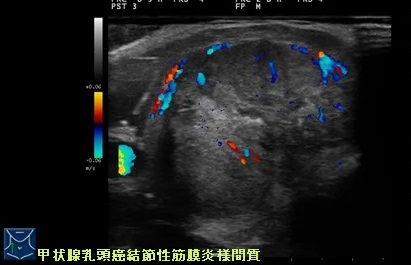 甲状腺乳頭癌結節性筋膜炎様間質(PTC-FS) 超音波(エコー)画像 甲状腺乳頭癌結節性筋膜炎様間質(PTC-FS) 超音波(エコー)画像