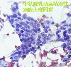 甲状腺乳頭癌結節性筋膜炎様間質(PTC-FS) 細胞診 甲状腺乳頭癌結節性筋膜炎様間質(PTC-FS) 細胞診