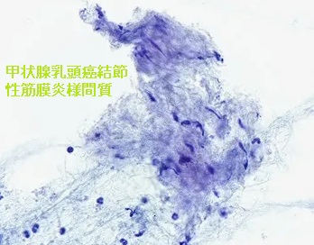 甲状腺乳頭癌結節性筋膜炎様間質(PTC-FS) 細胞診 甲状腺乳頭癌結節性筋膜炎様間質(PTC-FS) 細胞診