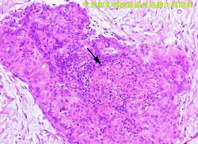 甲状腺乳頭癌結節性筋膜炎様間質(PTC-FS) 組織 甲状腺乳頭癌結節性筋膜炎様間質(PTC-FS) 組織