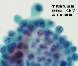 甲状腺乳頭癌 Hobnail(ホブネイル)細胞 甲状腺乳頭癌 Hobnail(ホブネイル)細胞