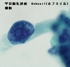 甲状腺乳頭癌 Hobnail(ホブネイル)細胞 甲状腺乳頭癌 Hobnail(ホブネイル)細胞