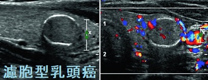 濾胞型乳頭癌 卵殻状石灰化 濾胞型乳頭癌 卵殻状石灰化