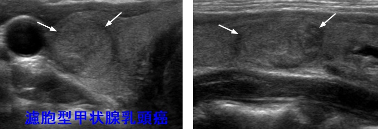 甲状腺濾胞型乳頭癌腺腫様結節 超音波(エコー)画像 甲状腺濾胞型乳頭癌腺腫様結節 超音波(エコー)画像