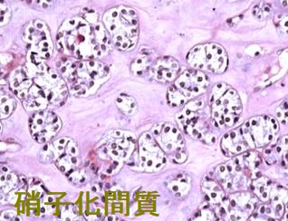 甲状腺乳頭癌 硝子化間質 甲状腺乳頭癌 硝子化間質