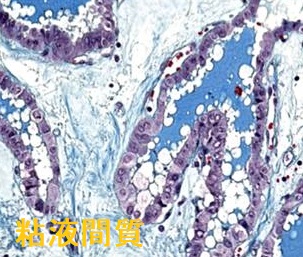 甲状腺乳頭癌 硝子化間質 甲状腺乳頭癌 硝子化間質