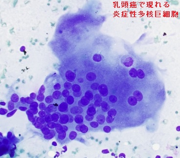 甲状腺乳頭癌 炎症性多核巨細胞 甲状腺乳頭癌 炎症性多核巨細胞