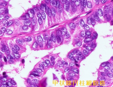 甲状腺円柱細胞癌 組織像 甲状腺円柱細胞癌 組織像