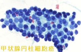 甲状腺円柱細胞癌 細胞診 甲状腺円柱細胞癌 細胞診