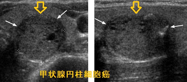甲状腺円柱細胞癌 超音波(エコー)画像 甲状腺円柱細胞癌 超音波(エコー)画像