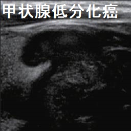 甲状腺低分化癌 甲状腺低分化癌