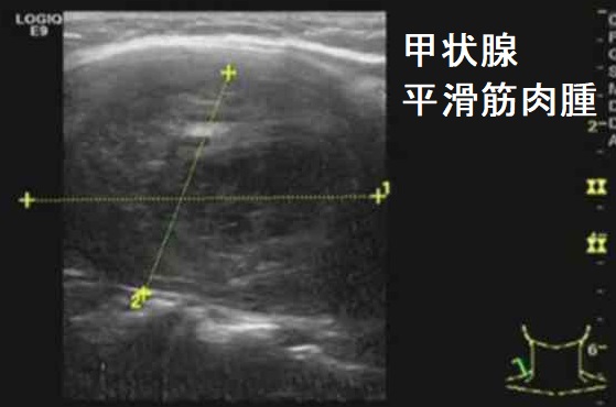 甲状腺平滑筋肉腫 超音波(エコー)画像 甲状腺平滑筋肉腫 超音波(エコー)画像