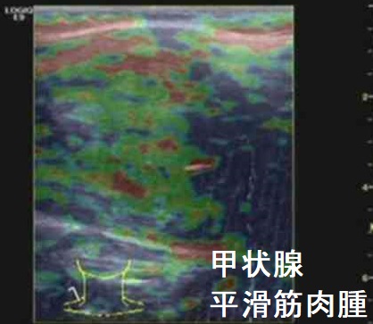 甲状腺平滑筋肉腫 エラストグラフィー 甲状腺平滑筋肉腫 エラストグラフィー