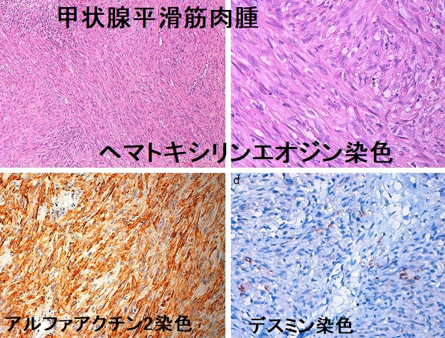 甲状腺平滑筋肉腫の組織 甲状腺平滑筋肉腫の組織