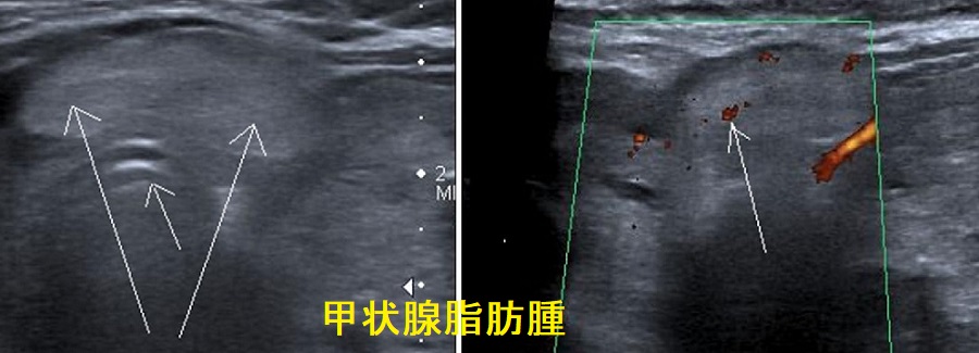 甲状腺脂肪腫 超音波(エコー)画像 甲状腺脂肪腫 超音波(エコー)画像