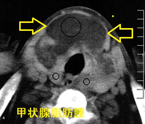 甲状腺脂肪腫 単純CT画像 甲状腺脂肪腫 単純CT画像
