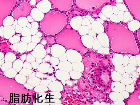 脂肪化生 組織像 脂肪化生 組織像