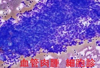 甲状腺血管肉腫 細胞診 甲状腺血管肉腫 細胞診