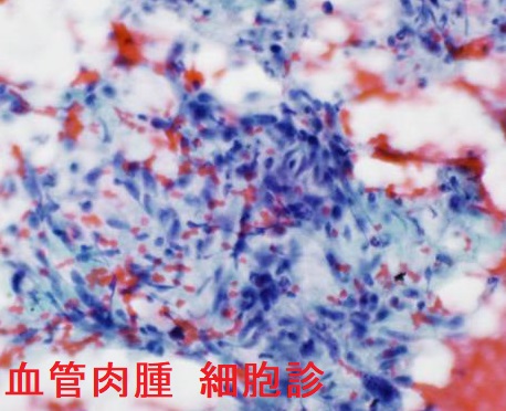 甲状腺血管肉腫 細胞診 甲状腺血管肉腫 細胞診
