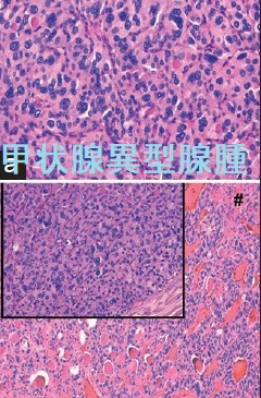 甲状腺異型腺腫 組織 甲状腺異型腺腫 組織