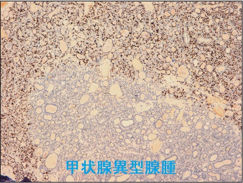 甲状腺異型腺腫 p53染色 甲状腺異型腺腫 p53染色