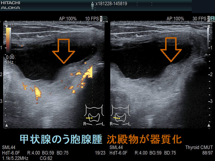 甲状腺のう胞腺腫 沈殿物が器質化 甲状腺のう胞腺腫 沈殿物が器質化