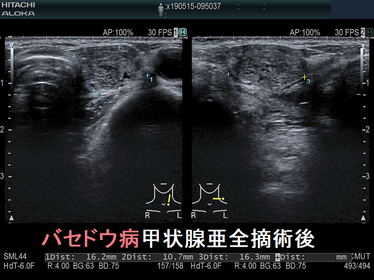 バセドウ病亜全摘術後 超音波(エコー)画像 バセドウ病亜全摘術後 超音波(エコー)画像