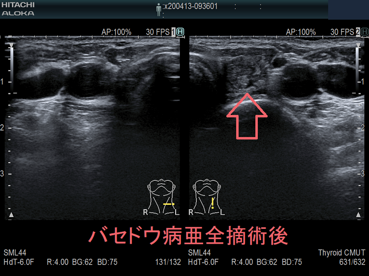 バセドウ病亜全摘術後 超音波(エコー)画像 バセドウ病亜全摘術後 超音波(エコー)画像