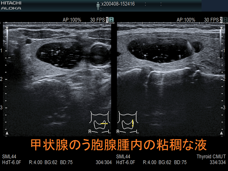 甲状腺のう胞腺腫 粘調な液 甲状腺のう胞腺腫内の粘稠な液