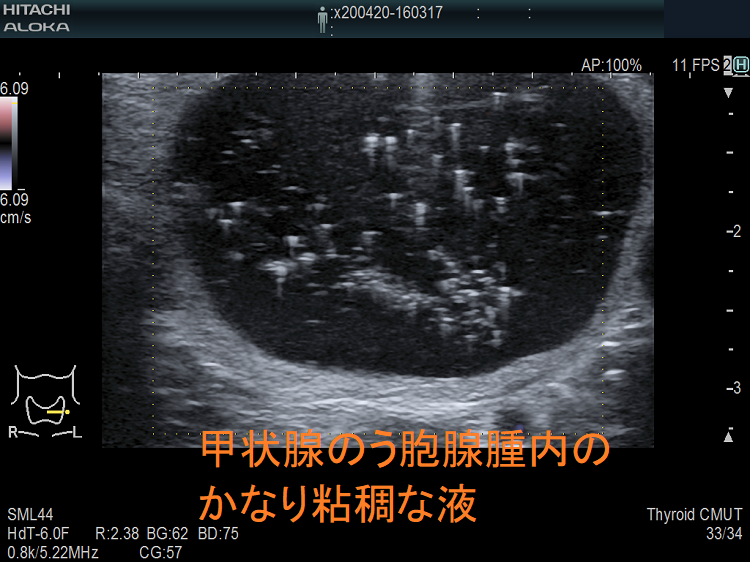 甲状腺のう胞腺腫内の、かなり粘調な液 甲状腺のう胞腺腫内の、かなり粘稠な液