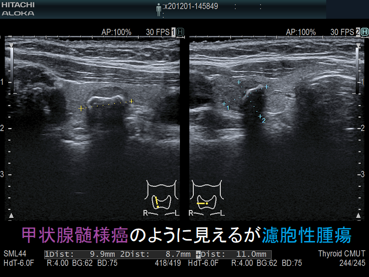 甲状腺髄様癌のように見えるが濾胞性腫瘍 甲状腺髄様癌のように見えるが濾胞性腫瘍
