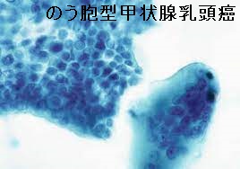 のう胞型甲状腺乳頭癌 細胞診 のう胞型甲状腺乳頭癌 細胞診