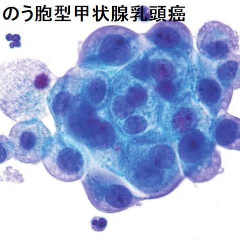 のう胞型甲状腺乳頭癌 細胞診 のう胞型甲状腺乳頭癌 細胞診