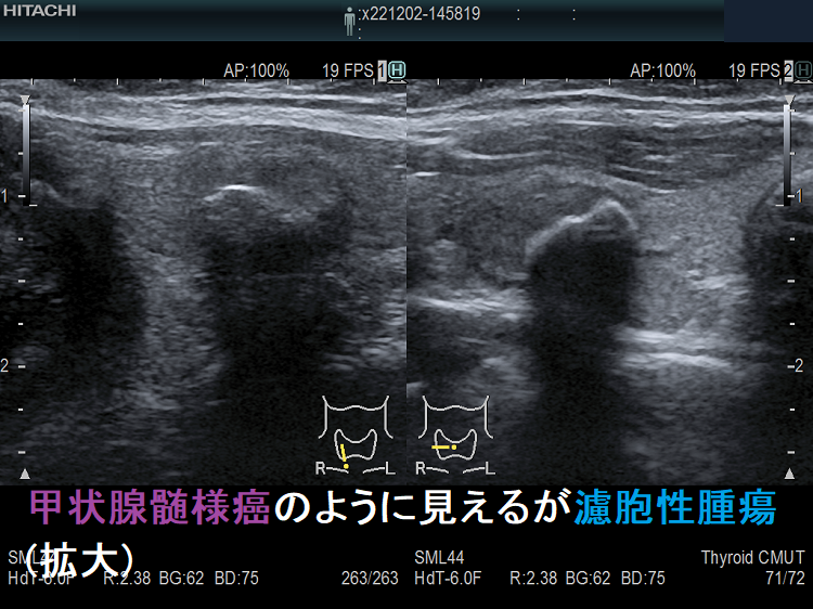 甲状腺髄様癌のように見えますが濾胞性腫瘍(拡大) 甲状腺髄様癌のように見えますが濾胞性腫瘍(拡大)