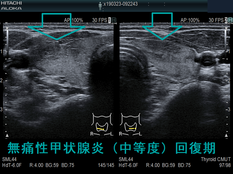 無痛性甲状腺炎(中等度)回復期 超音波(エコー)画像 無痛性甲状腺炎(中等度)回復期 超音波(エコー)画像