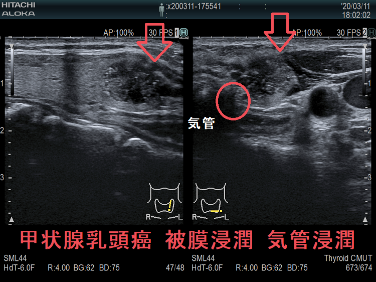甲状腺乳頭癌 被膜浸潤 気管浸潤 超音波(エコー)画像 甲状腺乳頭癌 被膜浸潤 気管浸潤 超音波(エコー)画像