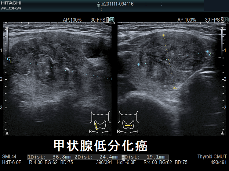 甲状腺低分化癌 超音波(エコー)画像 甲状腺低分化癌 超音波(エコー)画像