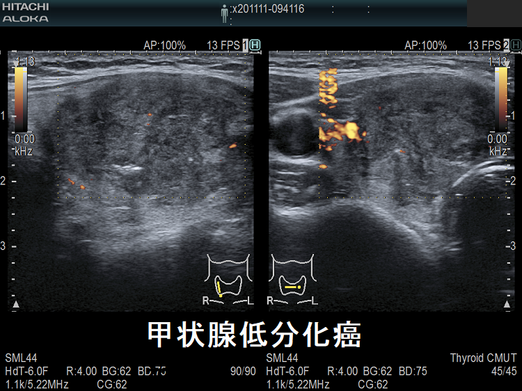 癌 難治性がんTNBCに対する新規標的分子としてRNA結合タンパク質