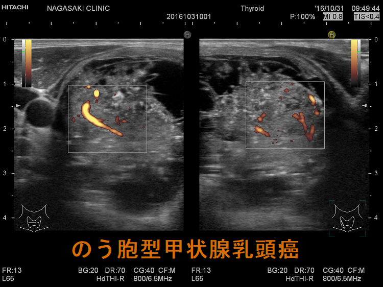 のう胞型甲状腺乳頭癌 超音波(エコー)画像 ドプラーモード のう胞型甲状腺乳頭癌 超音波(エコー)画像 ドプラーモード