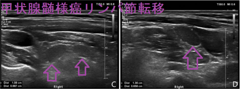 甲状腺髄様癌リンパ節転移 甲状腺髄様癌リンパ節転移