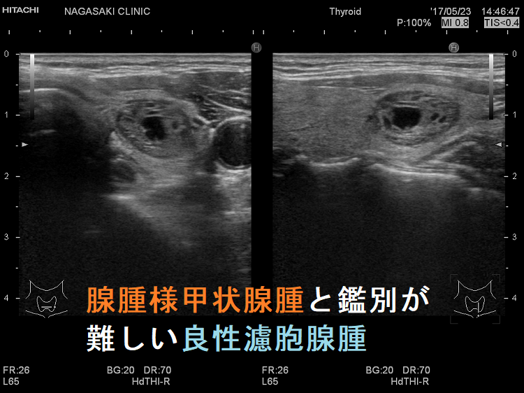 濾胞性腫瘍(腺腫様結節と鑑別難) 濾胞性腫瘍(腺腫様結節と鑑別難)