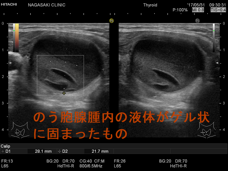 のう胞腺腫内の液体がゲル状に固まったもの のう胞腺腫内の液体がゲル状に固まったもの