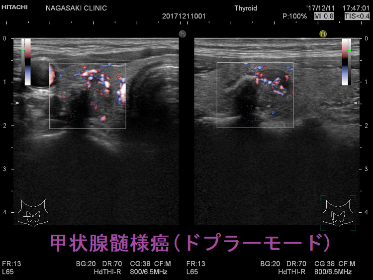 甲状腺髄様癌 超音波(エコー)画像(ドプラー) 甲状腺髄様癌 超音波(エコー)画像(ドプラー)