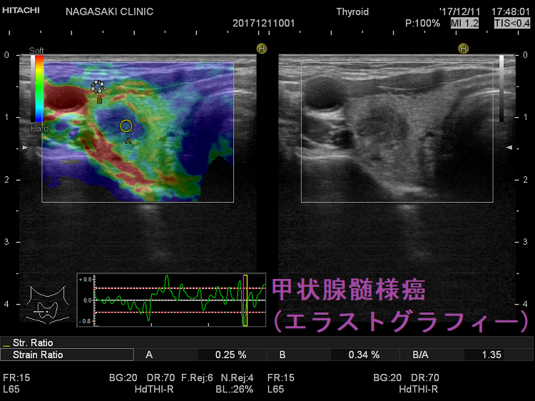 甲状腺髄様癌の超音波エコー検査[橋本病 バセドウ病 甲状腺機能